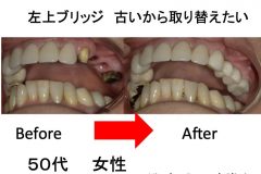 ブリッジ古いから取り替えたい
