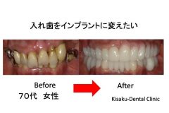 入れ歯をインプラントに