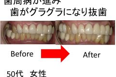歯周病が進み歯がグラグラいなり抜歯
