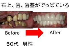 右上の歯と歯茎がでっぱている