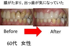 膿がたまり、出っ歯が気になっていた