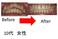 出っ歯なので口が閉じられない