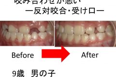 咬み合わせが悪い　反対咬合