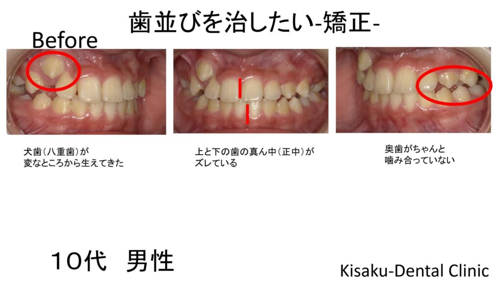 犬歯が変なところから生えてきた 八重歯 きさくデンタルクリニック