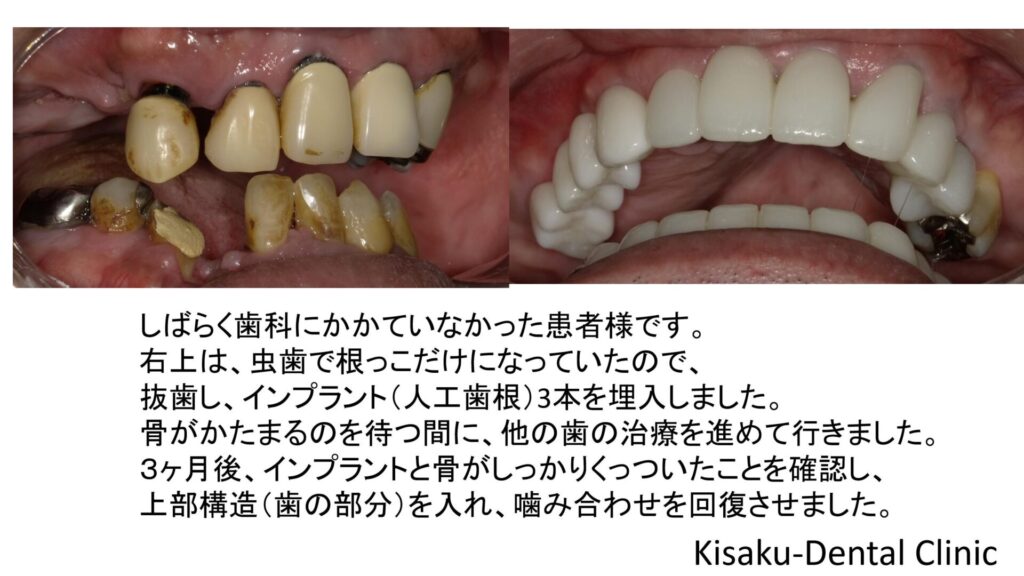 歯がガタガタなので全体的に治したい ー５０代男性ー きさくデンタルクリニック