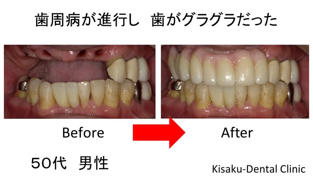 歯周病が進行し 歯がグラグラだったー50代 男性ーインプラント・ジルコニアセラミック - きさくデンタルクリニック