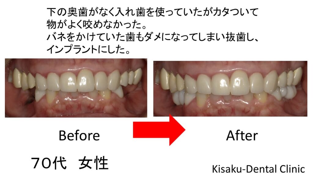 下の奥歯がなく入れ歯を使っていたが カタついて 物がよく咬めなかった バネをかけていた歯もダメになってしまい抜歯し インプラントにした ７０代 女性ーインプラント ジルコニアセラミック きさくデンタルクリニック