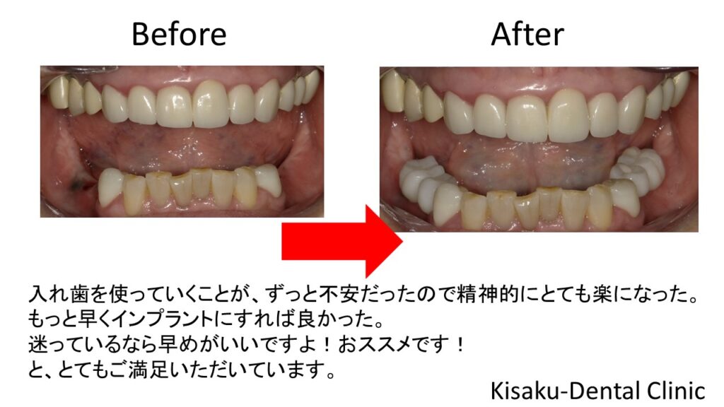 下の奥歯がなく入れ歯を使っていたが カタついて 物がよく咬めなかった バネをかけていた歯もダメになってしまい抜歯し インプラントにした ７０代 女性ーインプラント ジルコニアセラミック きさくデンタルクリニック