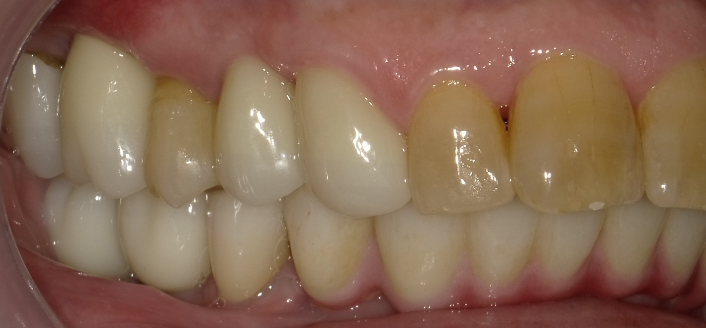 After image
